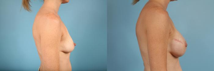 Before & After Nipple Sparing Mastectomy Case 100 View #3 View in Chicago, IL
