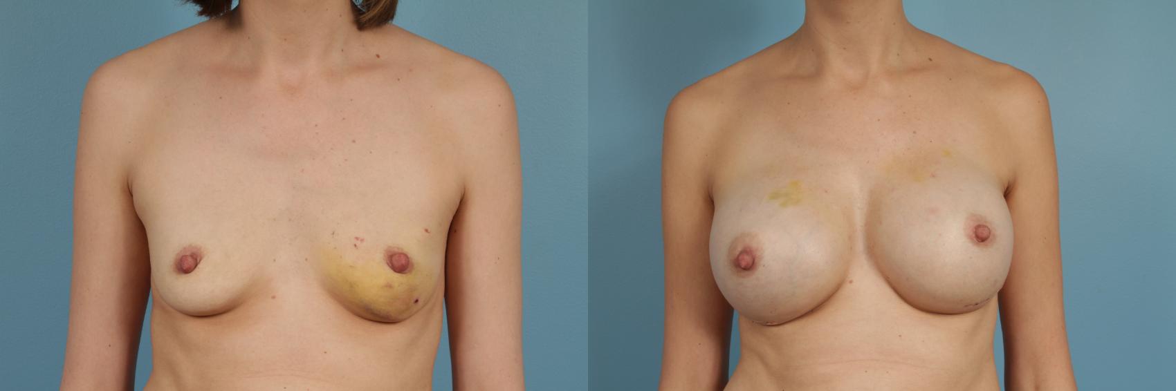 Before & After Nipple Sparing Mastectomy Case 258 View #1 View in Chicago, IL