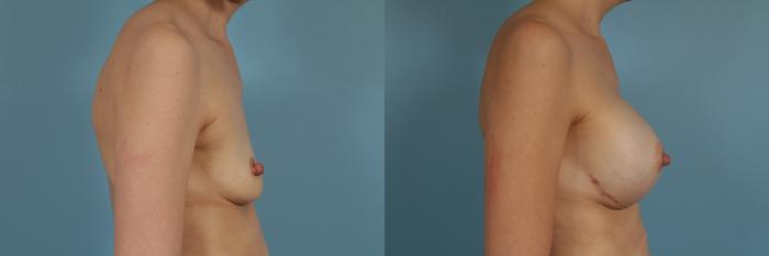 Before & After Nipple Sparing Mastectomy Case 258 View #3 View in Chicago, IL