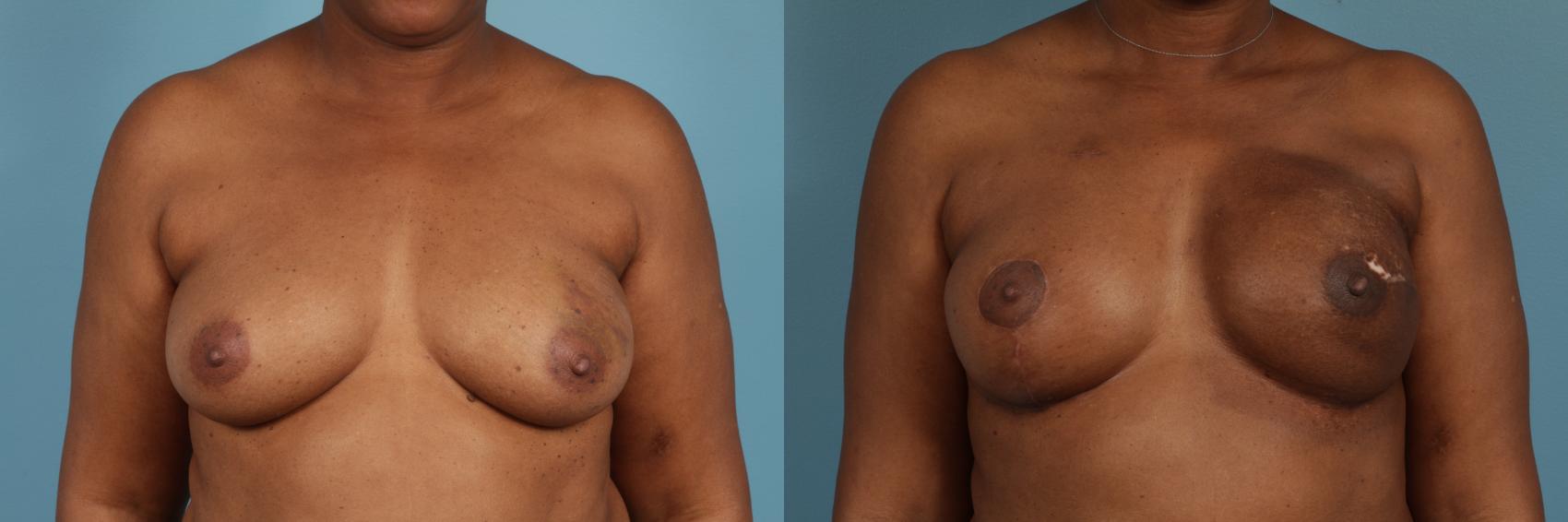 Before & After Nipple Sparing Mastectomy Case 284 View #1 View in Chicago, IL