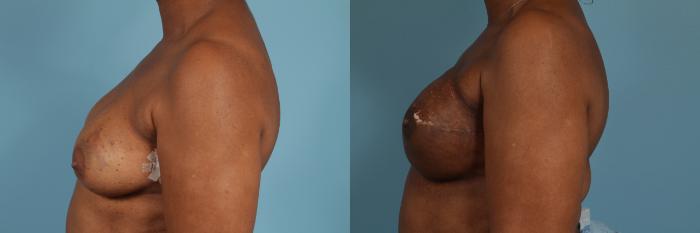 Before & After Nipple Sparing Mastectomy Case 284 View #2 View in Chicago, IL