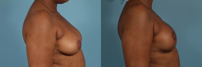 Before & After Nipple Sparing Mastectomy Case 284 View #3 View in Chicago, IL