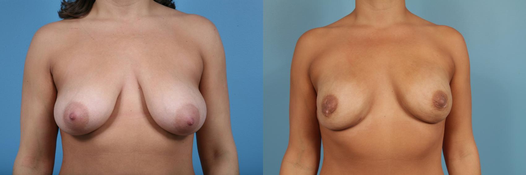 Before & After Nipple Sparing Mastectomy Case 83 View #1 View in Chicago, IL