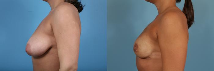 Before & After Nipple Sparing Mastectomy Case 83 View #2 View in Chicago, IL