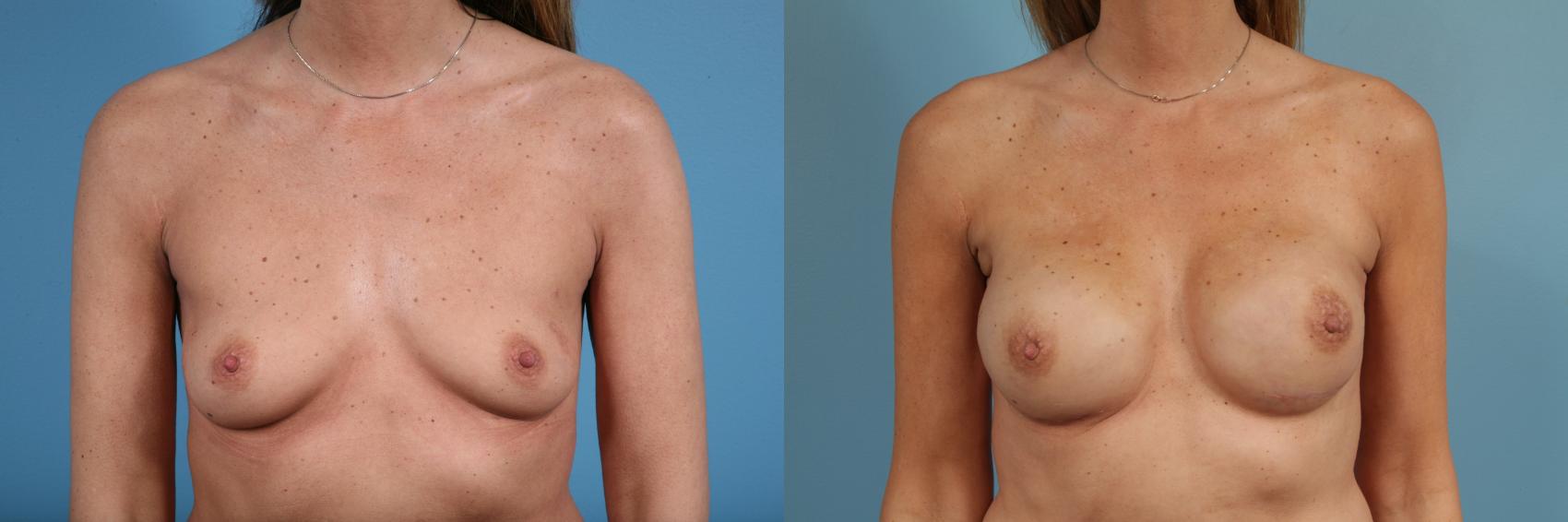 Before & After Nipple Sparing Mastectomy Case 92 View #1 View in Chicago, IL