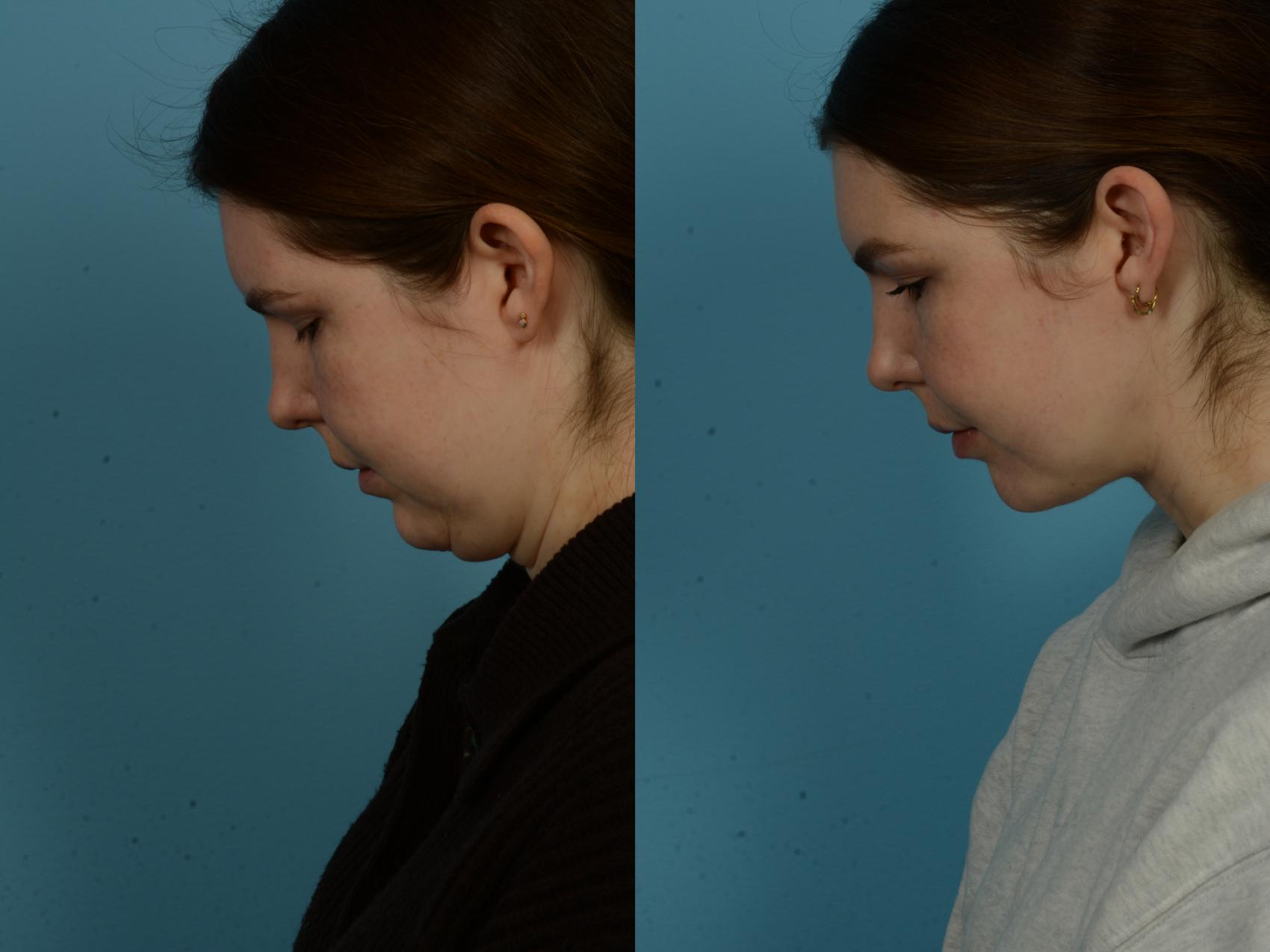 Before & After Precision TX Laser Case 1086 Connell View View in Chicago, IL