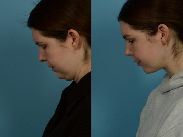 Before & After Precision TX Laser Case 1086 Connell View View in Chicago, IL