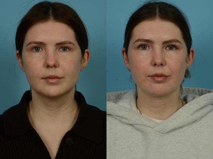 Before & After Precision TX Laser Case 1086 Front View in Chicago, IL