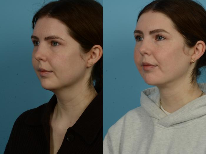 Before & After Precision TX Laser Case 1086 Left Oblique View in Chicago, IL