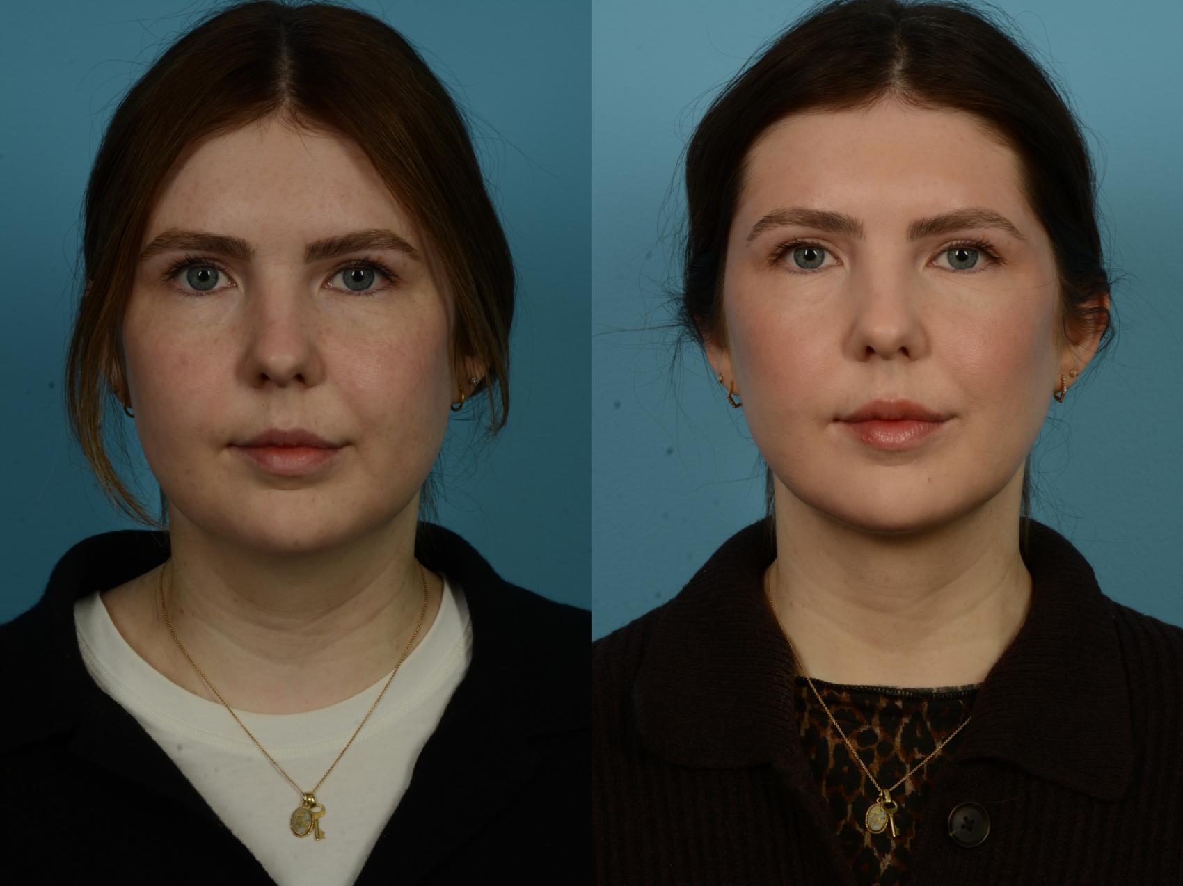 Before & After Precision TX Laser Case 1112 Front View in Chicago, IL