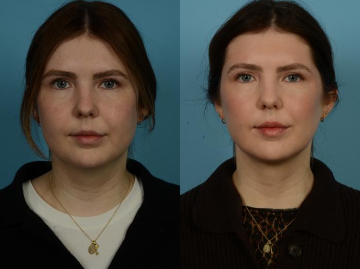 Before & After Precision TX Laser Case 1112 Front View in Chicago, IL