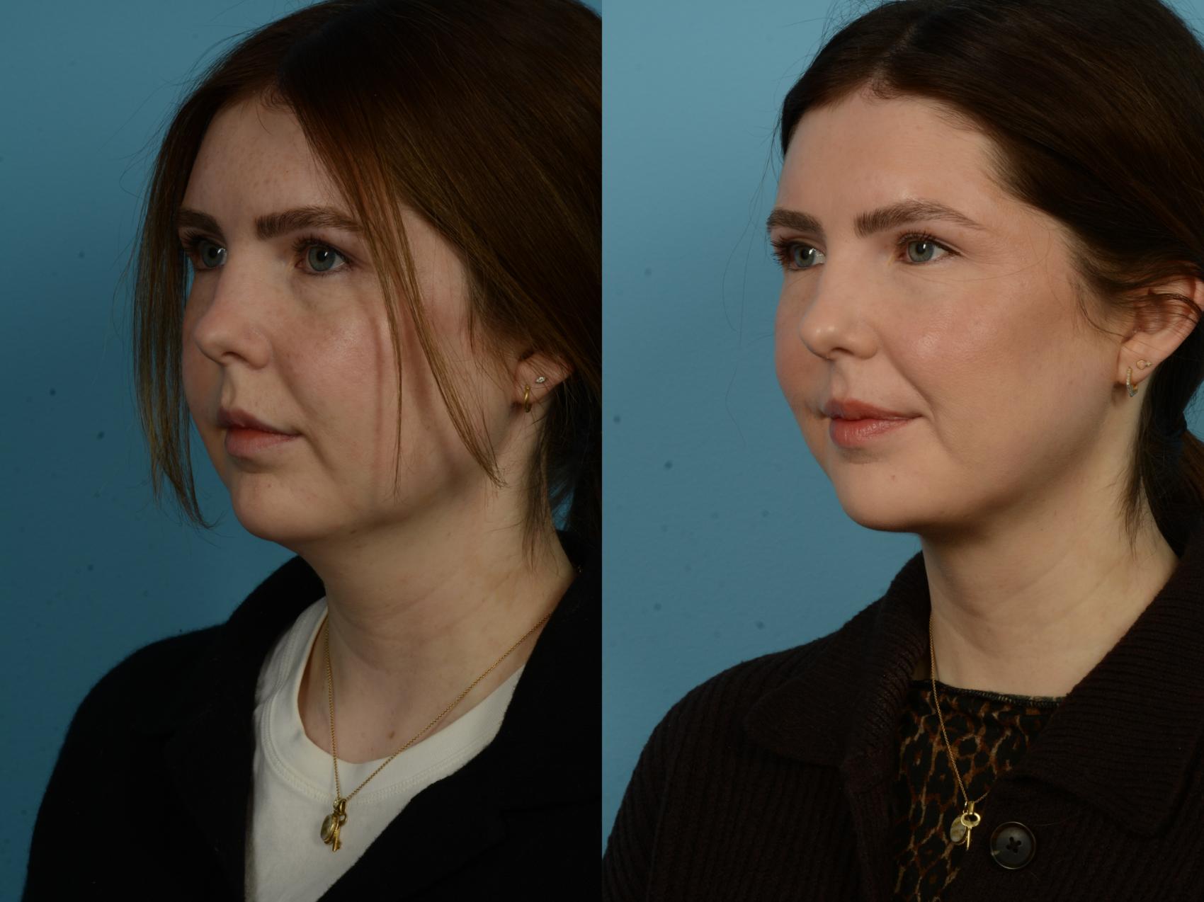 Before & After Precision TX Laser Case 1112 Left Oblique View in Chicago, IL