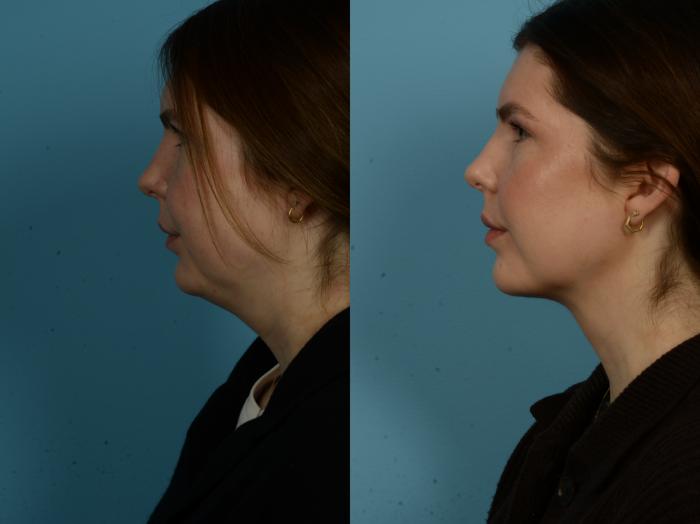 Before & After Precision TX Laser Case 1112 Left Side View in Chicago, IL