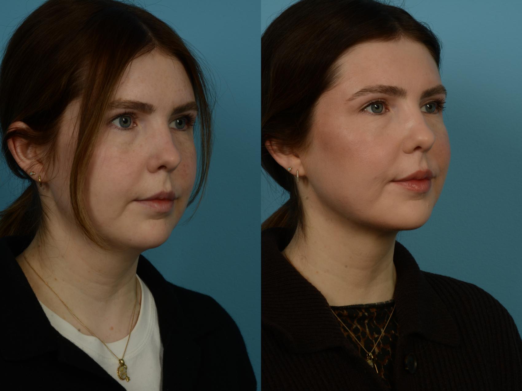 Before & After Precision TX Laser Case 1112 Right Oblique View in Chicago, IL