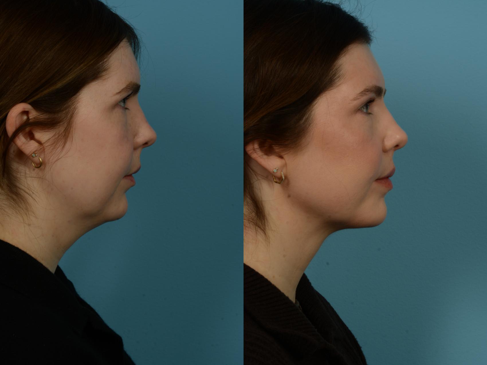 Before & After Precision TX Laser Case 1112 Right Side View in Chicago, IL