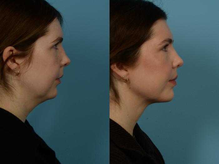 Before & After Precision TX Laser Case 1112 Right Side View in Chicago, IL