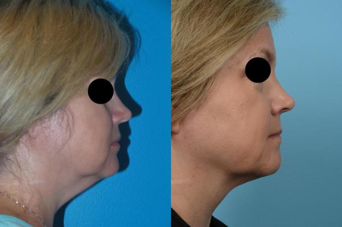 Before & After Precision TX Laser Case 459 View #1 View in Chicago, IL