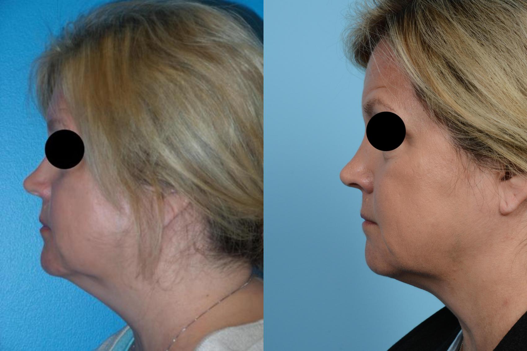 Before & After Precision TX Laser Case 459 View #2 View in Chicago, IL