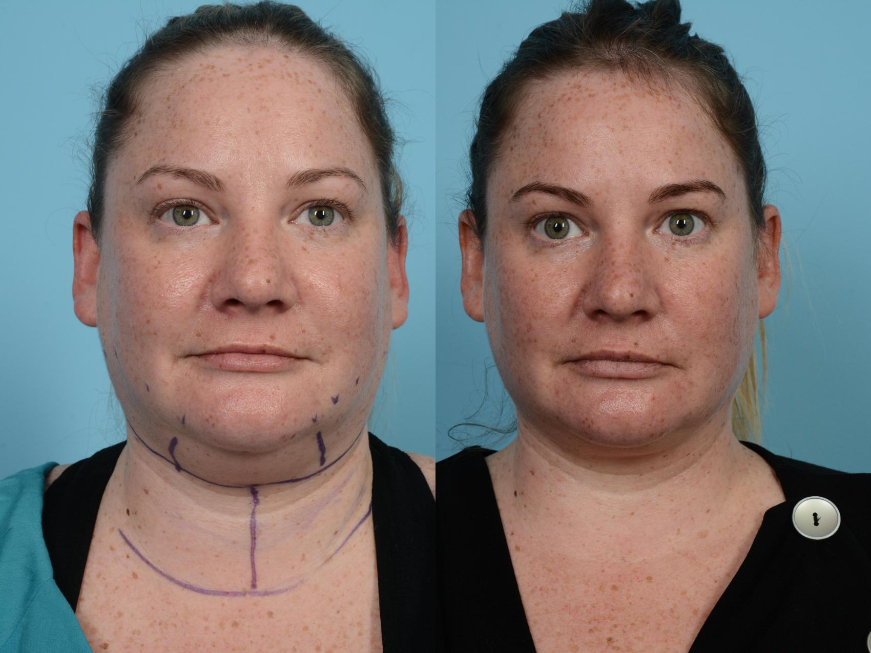 Before & After Precision TX Laser Case 583 View #1 View in Chicago, IL