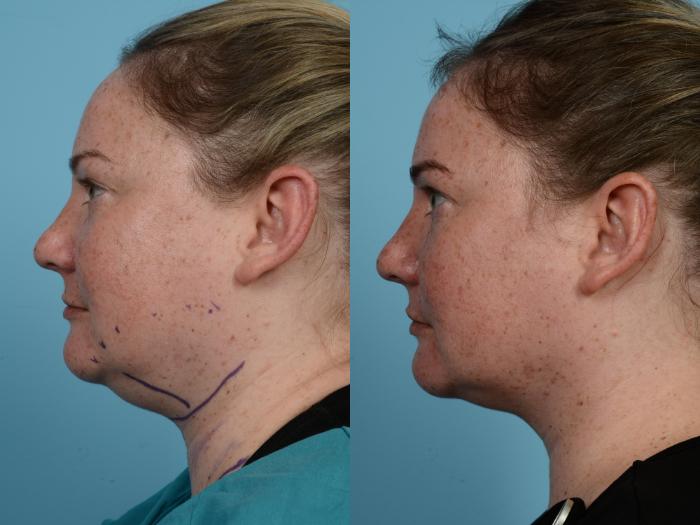 Before & After Precision TX Laser Case 583 View #2 View in Chicago, IL