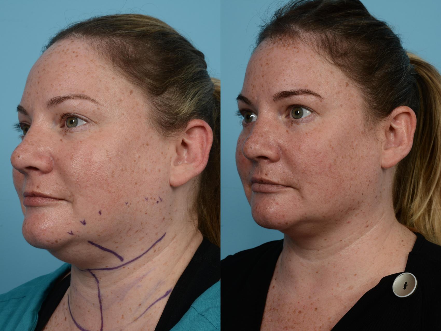 Before & After Precision TX Laser Case 583 View #3 View in Chicago, IL