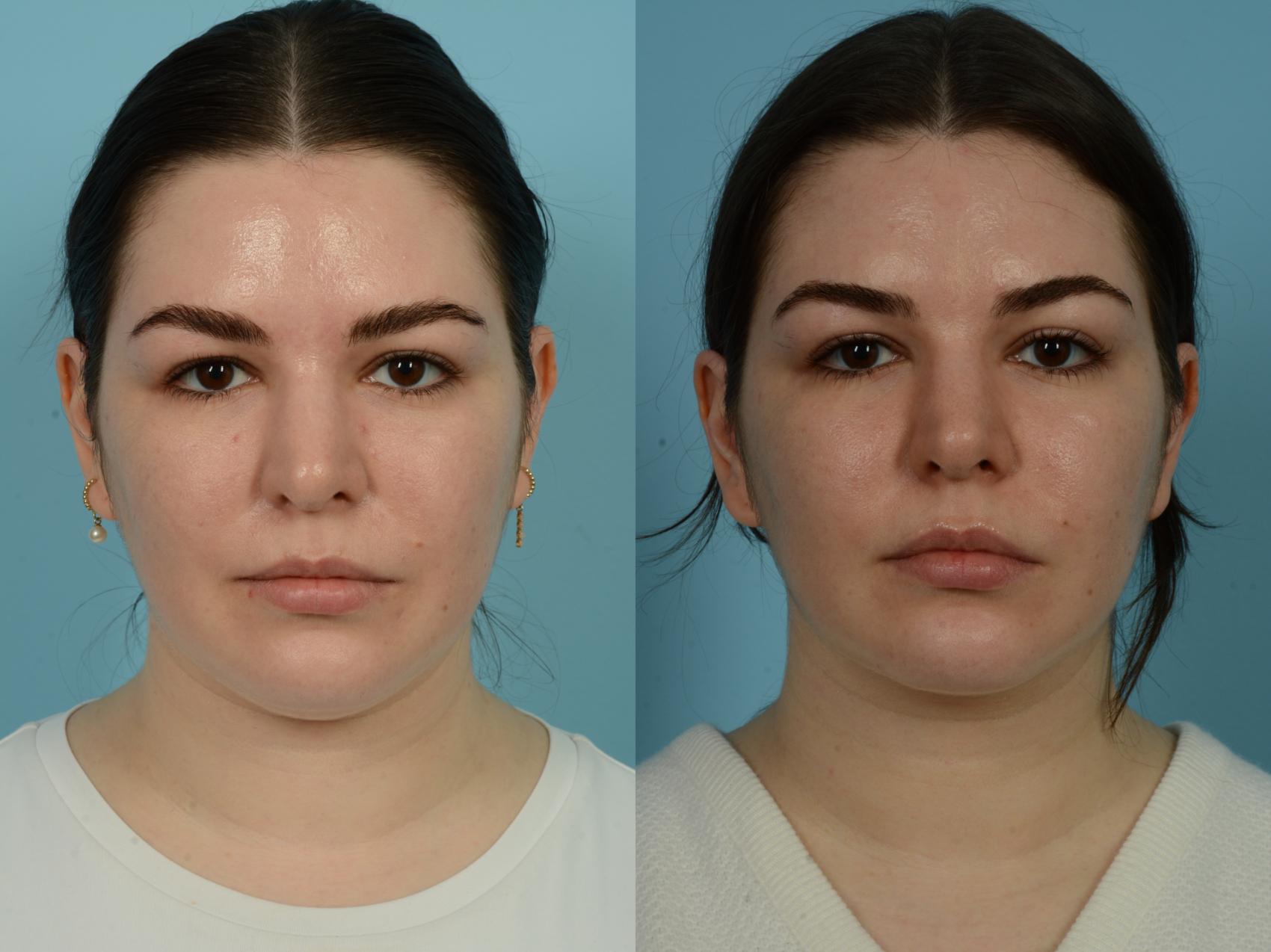 Before & After Precision TX Laser Case 852 Front View in Chicago, IL