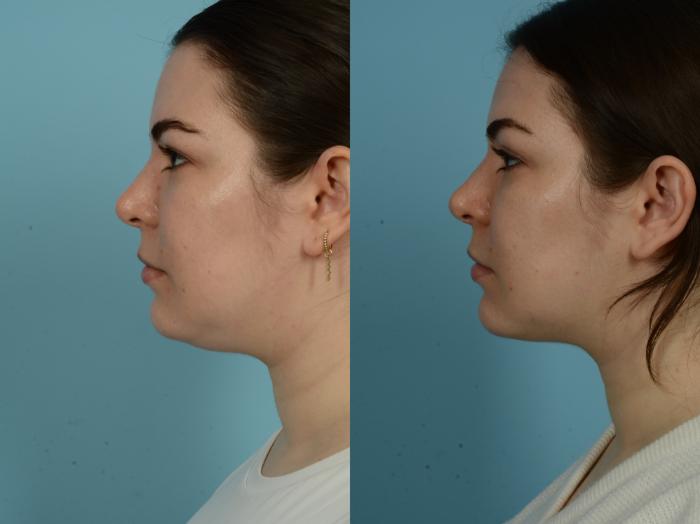 Before & After Precision TX Laser Case 852 Left Side View in Chicago, IL