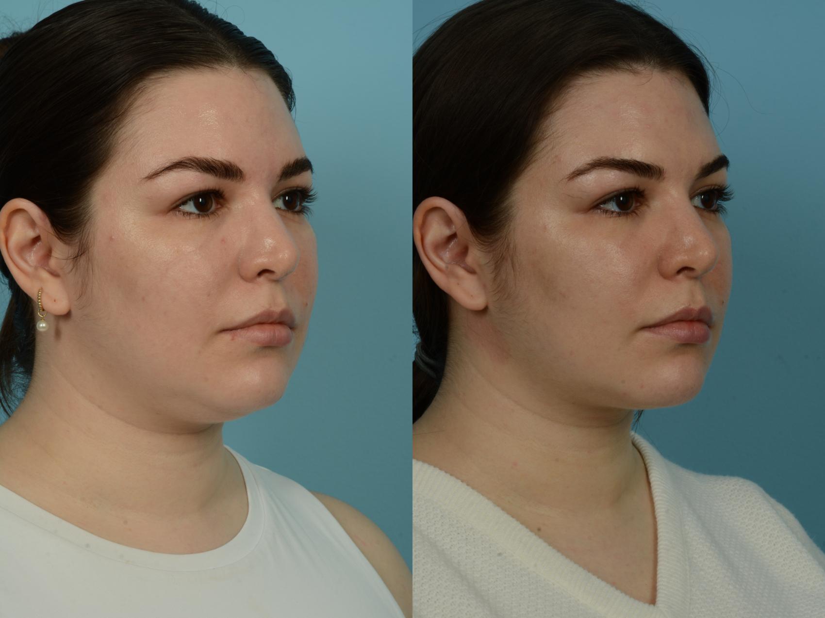 Before & After Precision TX Laser Case 852 Right Oblique View in Chicago, IL