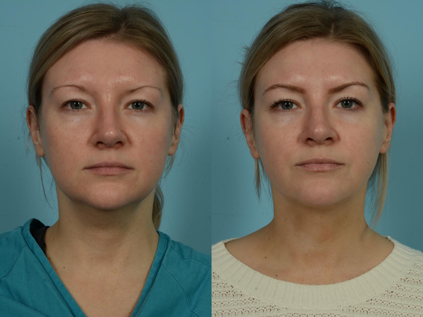 Before & After Precision TX Laser Case 870 Front View in Chicago, IL