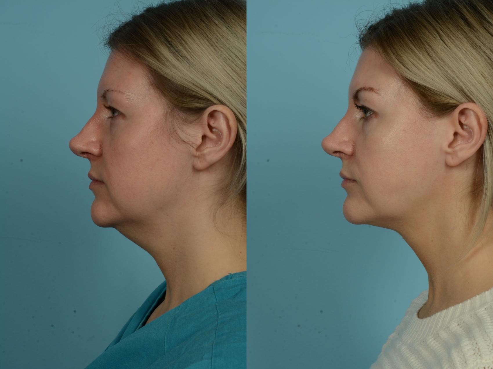 Before & After Precision TX Laser Case 870 Left Side View in Chicago, IL