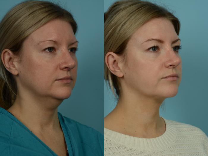 Before & After Precision TX Laser Case 870 Right Oblique View in Chicago, IL