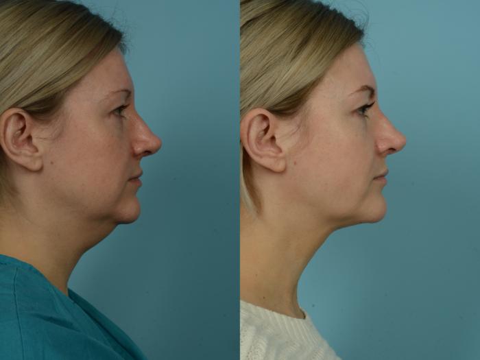 Before & After Precision TX Laser Case 870 Right Side View in Chicago, IL