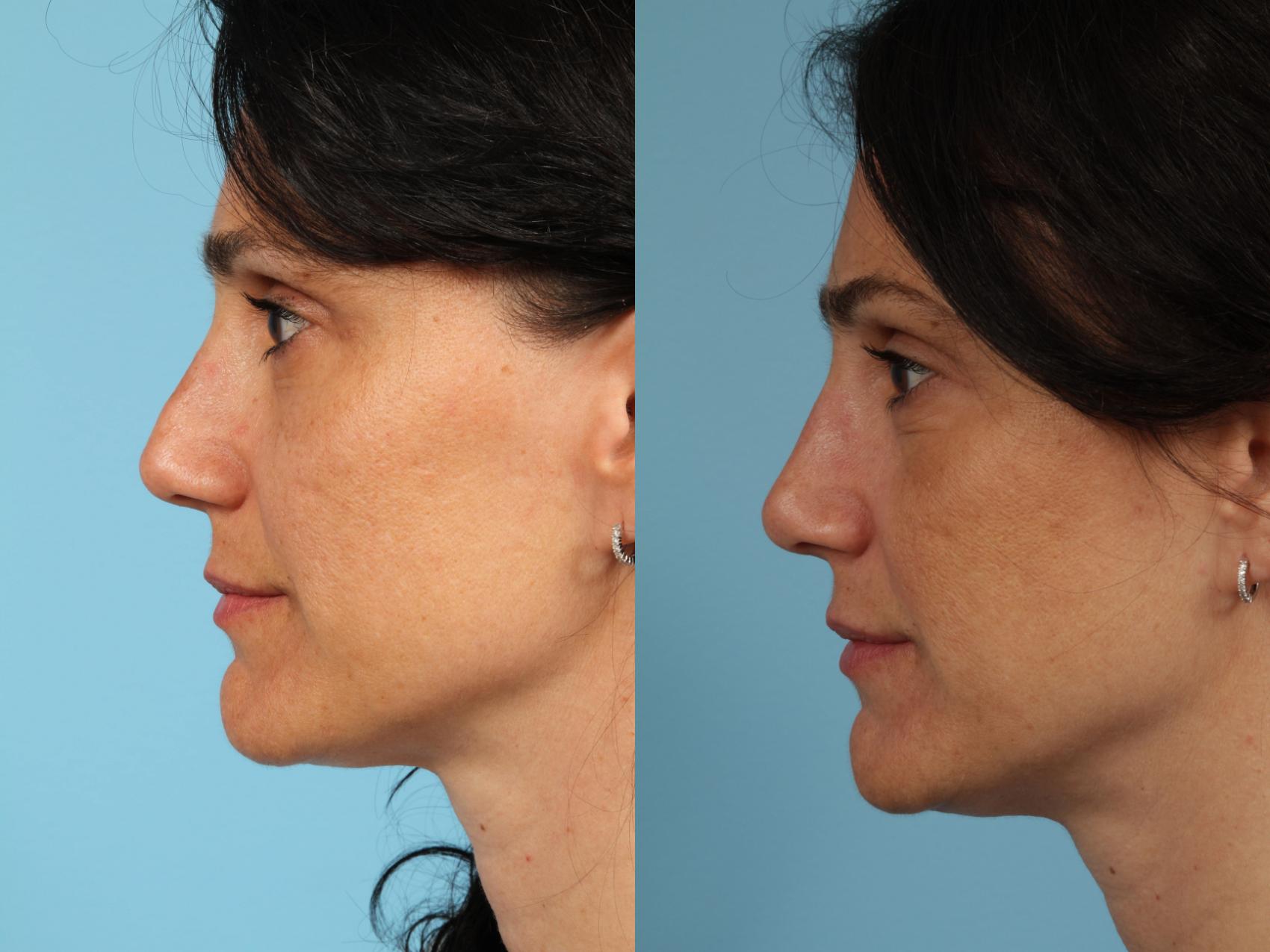 Before & After Revision Rhinoplasty by Dr. Mustoe Case 105 View #1 View in Chicago, IL