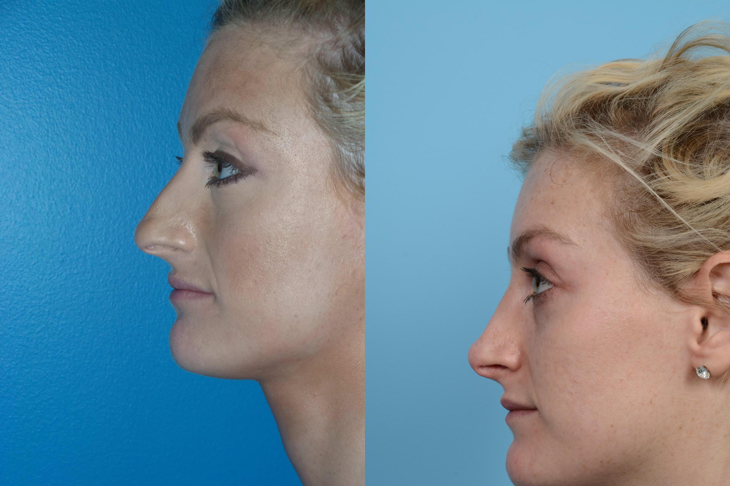 Before & After Revision Rhinoplasty by Dr. Mustoe Case 448 View #1 View in Chicago, IL