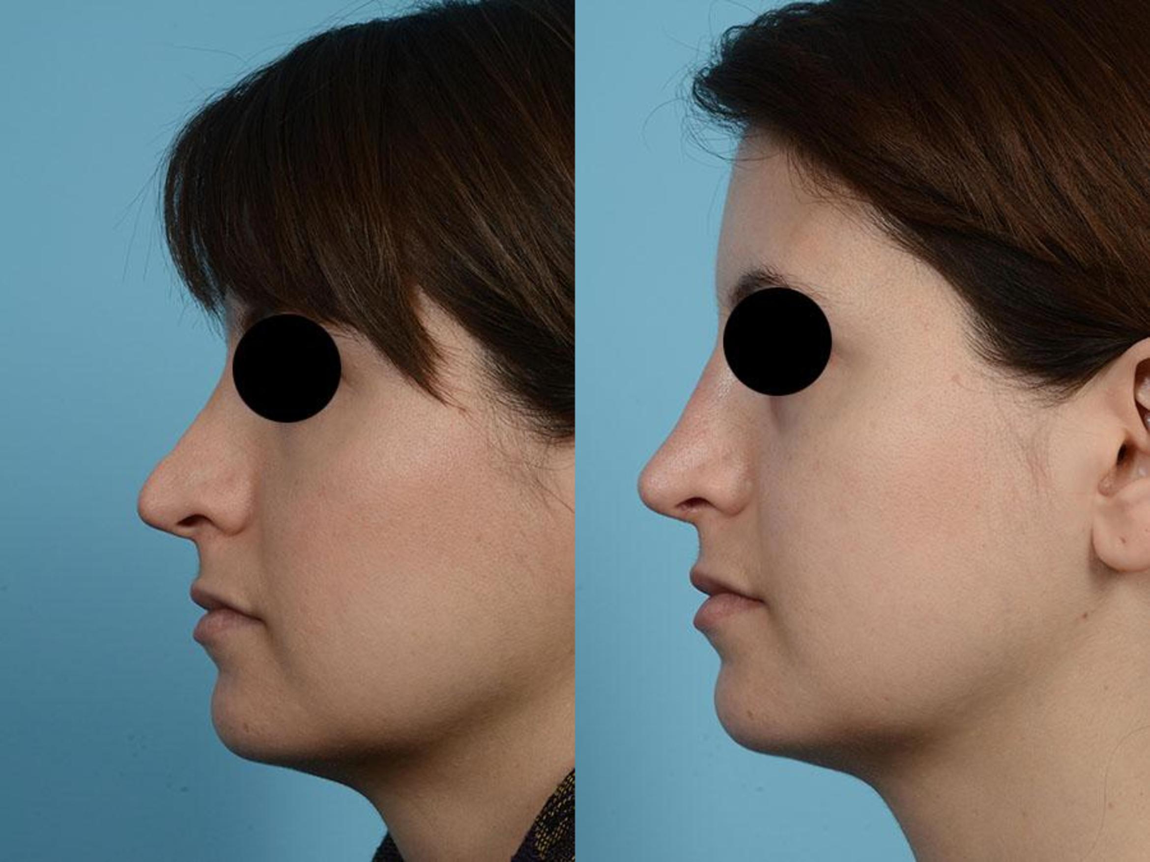 Before & After Revision Rhinoplasty by Dr. Mustoe Case 528 View #1 View in Chicago, IL