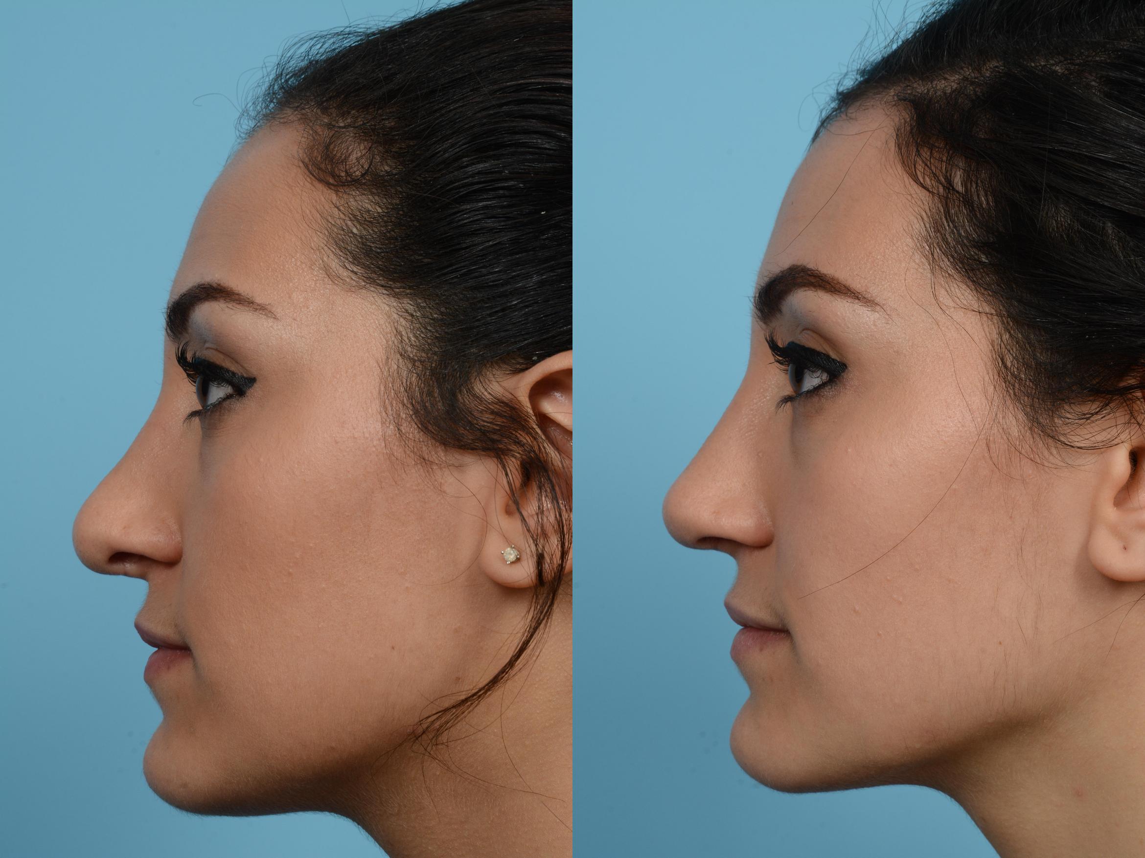 Before & After Revision Rhinoplasty by Dr. Mustoe Case 543 View #1 View in Chicago, IL