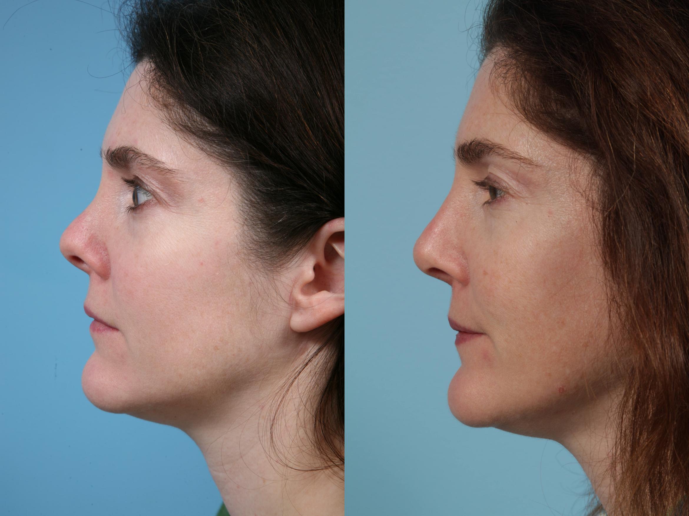Before & After Revision Rhinoplasty by Dr. Mustoe Case 98 View #1 View in Chicago, IL