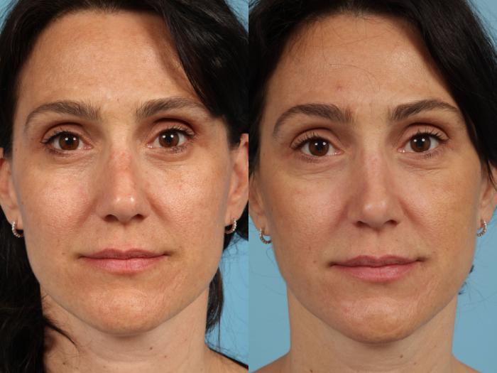 Before & After Revision Rhinoplasty by Dr. Mustoe Case 105 View #2 View in Chicago, IL