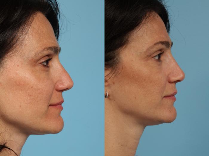 Before & After Revision Rhinoplasty by Dr. Mustoe Case 105 View #3 View in Chicago, IL