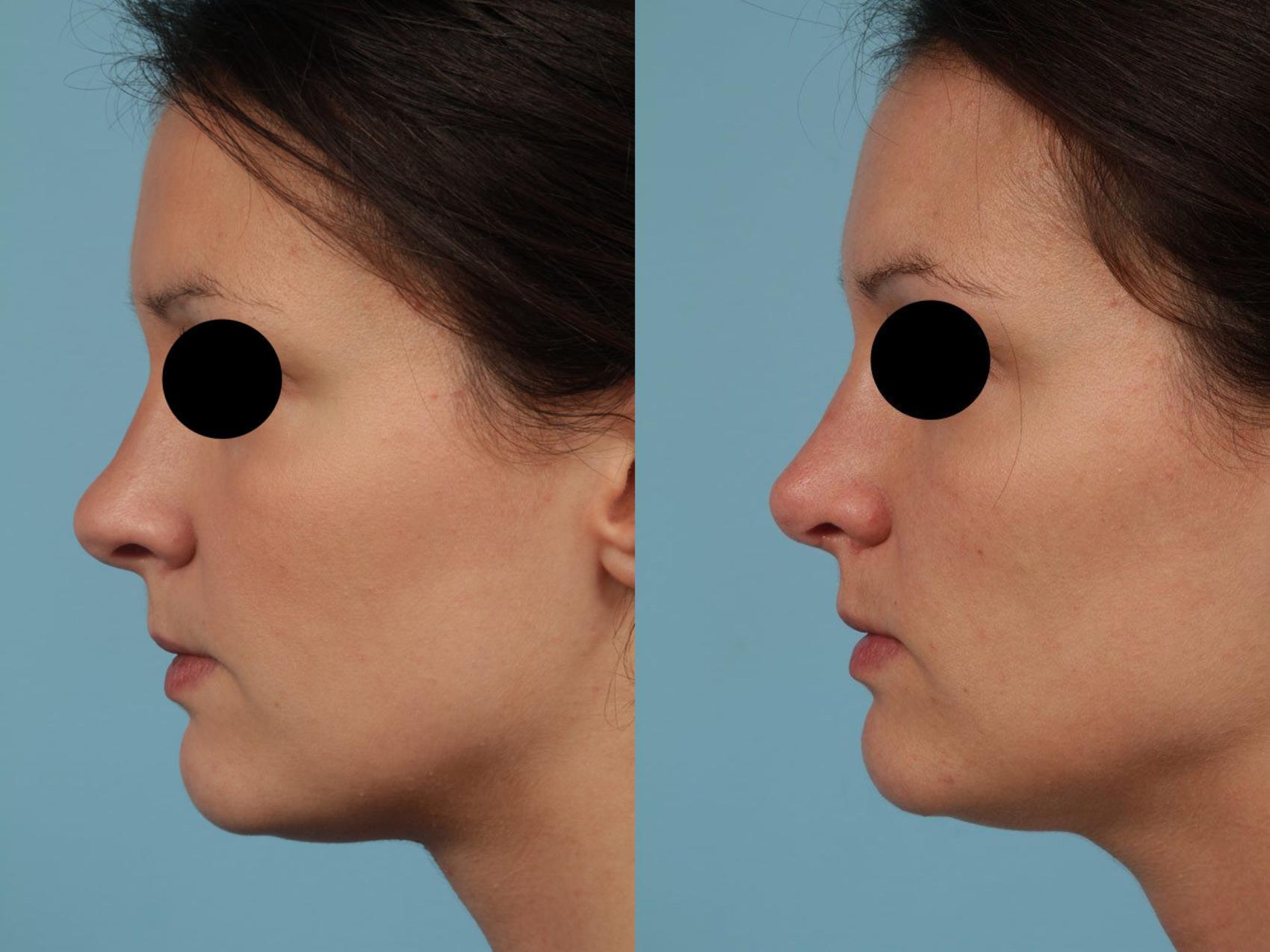 Before & After Revision Rhinoplasty by Dr. Mustoe Case 234 View #1 View in Chicago, IL