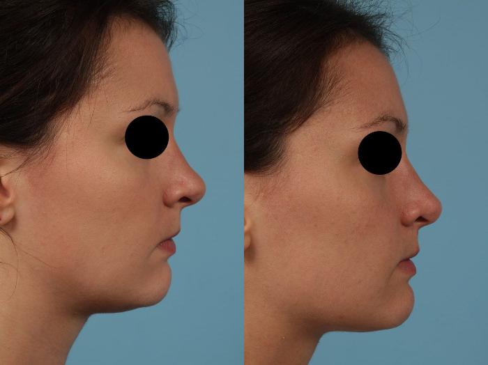 Before & After Revision Rhinoplasty by Dr. Mustoe Case 234 View #2 View in Chicago, IL