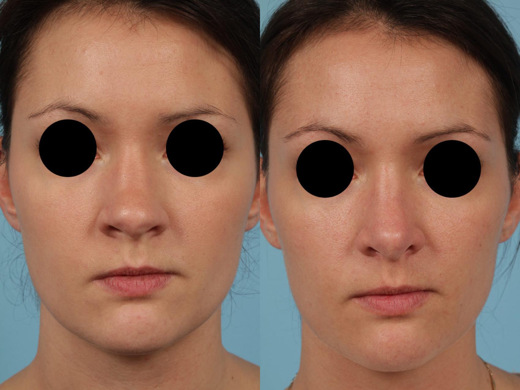 Before & After Revision Rhinoplasty by Dr. Mustoe Case 234 View #3 View in Chicago, IL