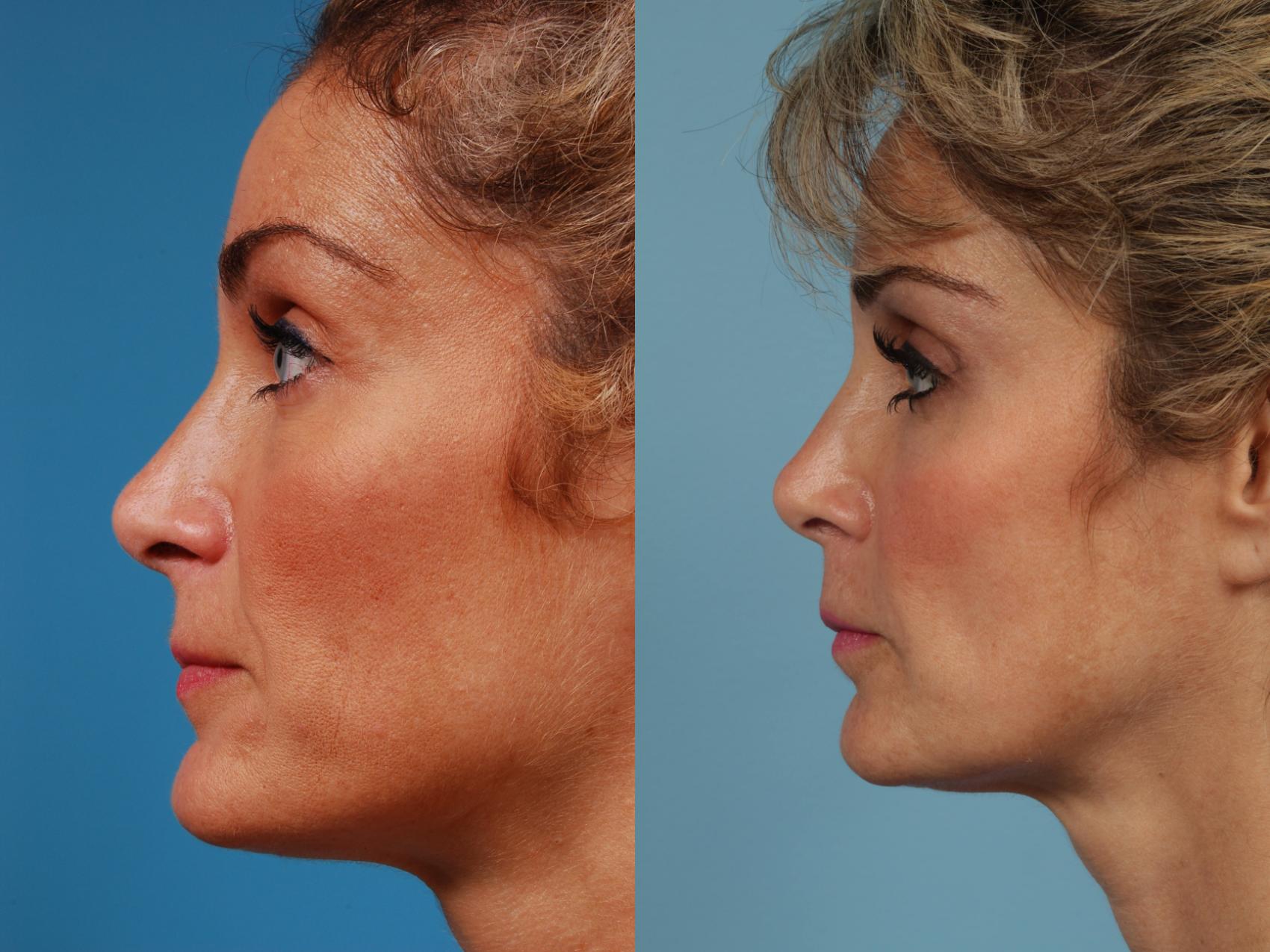 Before & After Revision Rhinoplasty by Dr. Mustoe Case 242 View #1 View in Chicago, IL