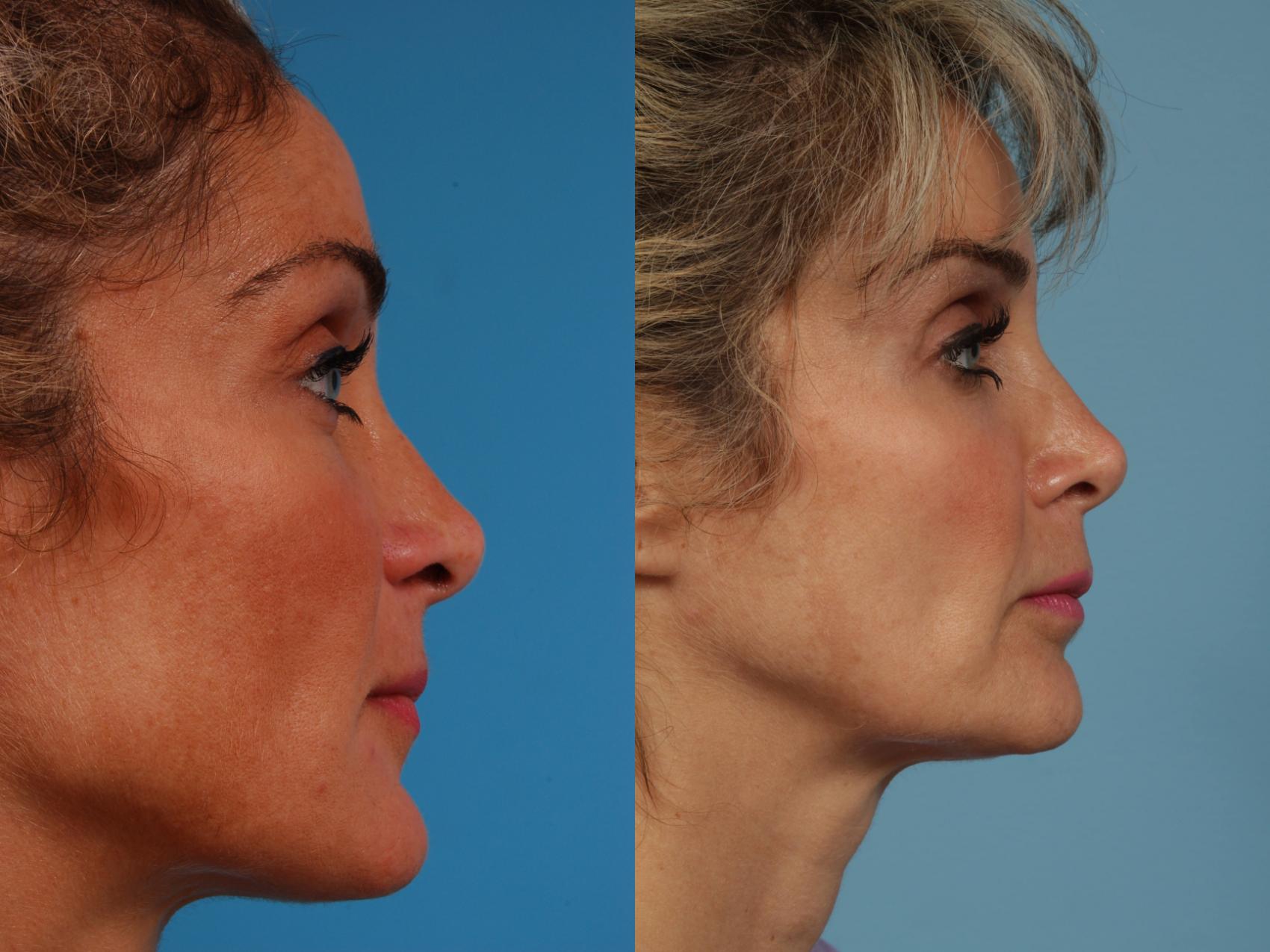 Before & After Revision Rhinoplasty by Dr. Mustoe Case 242 View #4 View in Chicago, IL