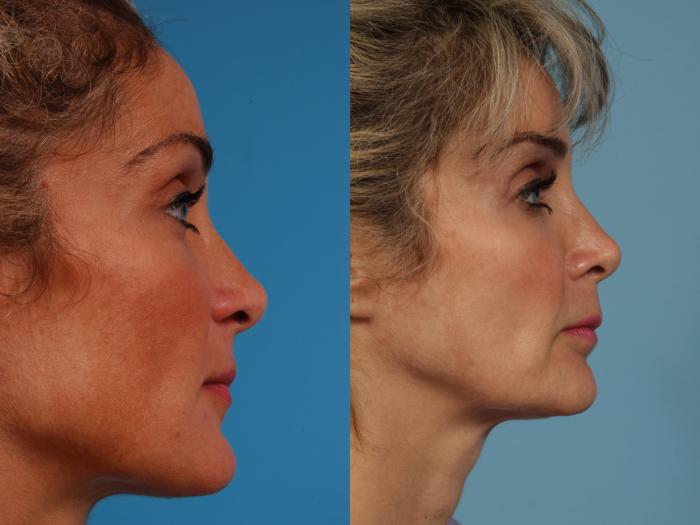 Before & After Revision Rhinoplasty by Dr. Mustoe Case 242 View #4 View in Chicago, IL