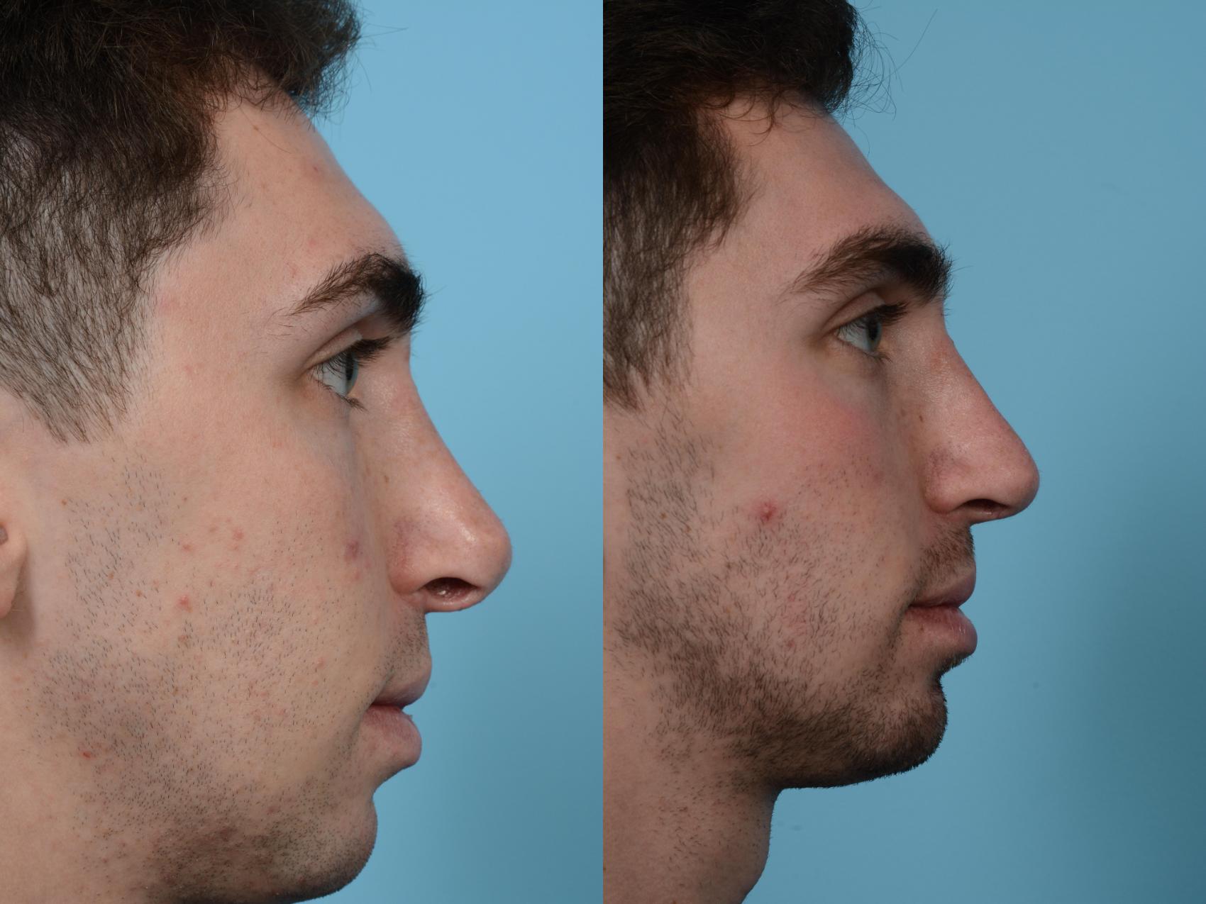 Before & After Revision Rhinoplasty by Dr. Mustoe Case 491 View #1 View in Chicago, IL