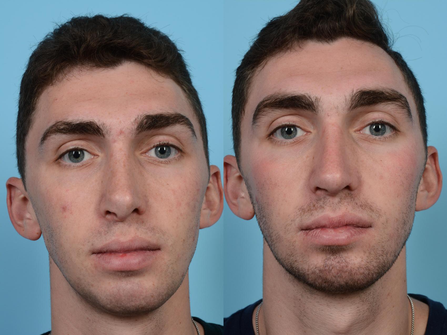 Before & After Revision Rhinoplasty by Dr. Mustoe Case 491 View #2 View in Chicago, IL