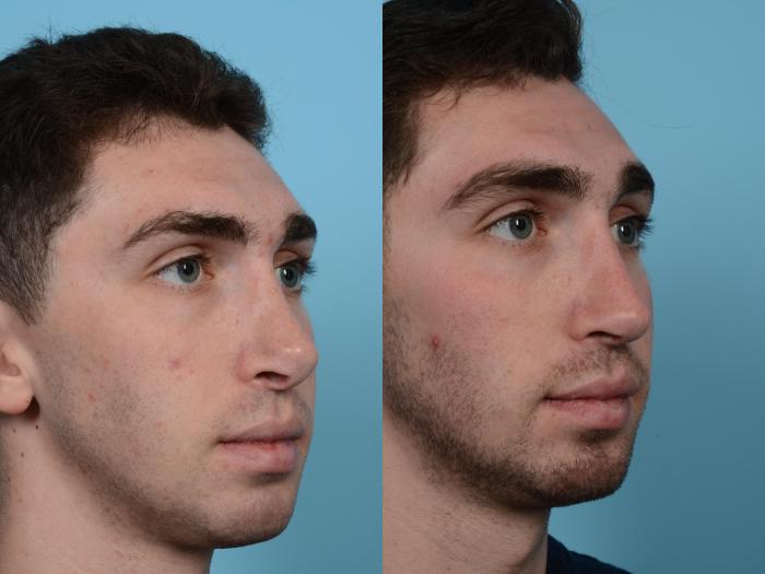 Before & After Revision Rhinoplasty by Dr. Mustoe Case 491 View #3 View in Chicago, IL