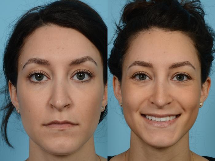 Before & After Revision Rhinoplasty by Dr. Mustoe Case 511 View #2 View in Chicago, IL