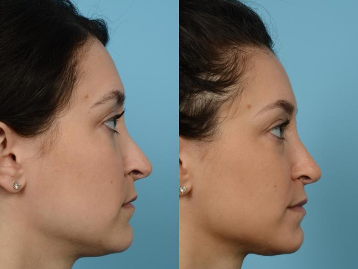 Before & After Revision Rhinoplasty by Dr. Mustoe Case 511 View #3 View in Chicago, IL
